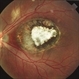 Macular Coloboma OS Macular Coloboma OS